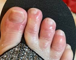 Touched By Lyme Self Isolation Covid Toes And Projectile Vomiting