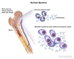 Although bone marrow cancer is not contagious, its exact cause is not known. Bone Marrow Neoplasm Mybiosource Learning Center