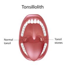 We did not find results for: Tonsillithiasis Tonsil Stones Otolaryngology Specialists Of North Texas