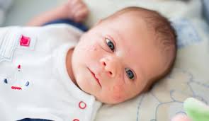 Bebeklerde Ucu Iltihapli Sivilce Haberleri Yasemin