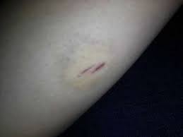 Blauer Ring Um Wunde Gesundheit