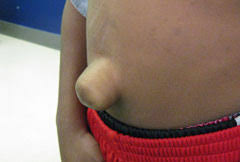 The first two are of when it really started to get bad. Umbilical Hernia Surgery Johns Hopkins All Children S Hospital