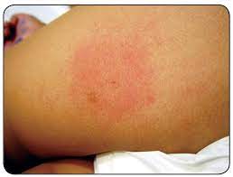 A scorpion sting may or may not swell noticeably. Scielo Brasil Clinical Update On Scorpion Envenoming Clinical Update On Scorpion Envenoming