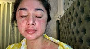 Banyak Yang Ragu Ruam Bukan Gejala Covid 19 Dewi Perssik Jelaskan Ini