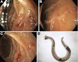 Image result for Hookworm