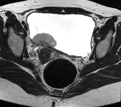 Transitional Cell Carcinoma Of The Bladder Staging Radiology Reference Article Radiopaedia Org