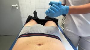 Semen congestion is treated by a nurse