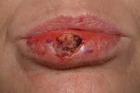 Image result for Lip Cancer