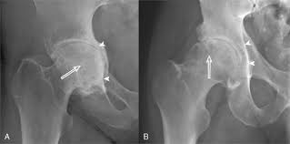 Image result for XRay Changes in Rheumatic Conditions