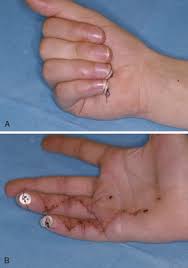 This positions the fdp tendon repair proximal to the skin incision, and counteracts the effect of the oblique retinacular ligament. Flexor Tendon Repairs With Novel Sutures And Devices Plastic Surgery Key