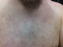 Image result for sweat rash on back