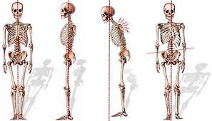 It helps in brainstorming to identify possible causes of a problem and in sorting ideas into useful categories. Spinal Deformities The Spine Hospital At The Neurological Institute Of New York