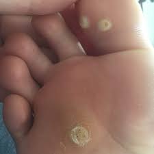 Image result for verruca
