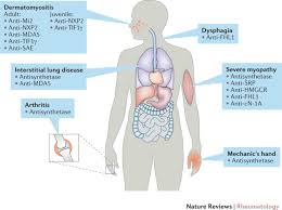 Statin induced necrotizing autoimmune myopathy (sinam) is a recently characterized entity belonging to the spectrum of statin myotoxicity. New Tools For Diagnosis And Therapy Nature Reviews Rheumatology