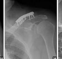 The precontoured locking compressive distal clavicle plate ...