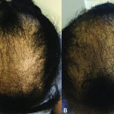 Jumping forward to feb 2017 my hair is still thin and my ferritin has reached 27. Pdf Hair Regrowth In 2 Patients With Recalcitrant Central Centrifugal Cicatricial Alopecia After Use Of Topical Metformin