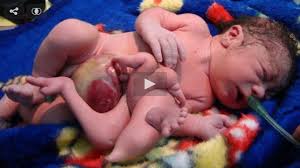 Some researchers and campaigners are convinced that depleted uranium left in the environment by spent munitions causes cancer, birth defects and other ill effects in people exposed to it. Search Results For Depleted Uranium Cancer There It Is Org