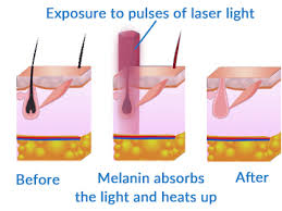 We did not find results for: Laser Hair Removal Of Baby Hairs Has Caused Thinning Hair