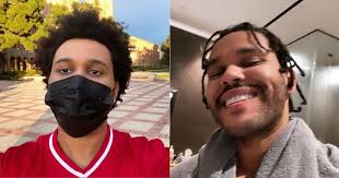 These things are normal and shouldn't cause concern. The Weeknd S After Surgery Face In Save Your Tears Video Shocks Fans