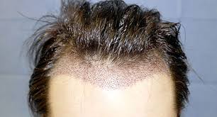 Dhi Sac Ekimi Hair Transplant Best Hair Transplant Hair