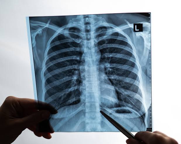 A standard chest X-ray does not require fasting, as food in your stomach won't block the view of your lungs or heart., AI generated
