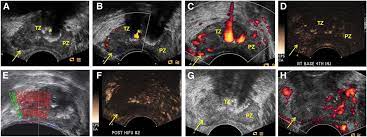 The most accurate way to diagnose and stage prostate cancer is a biopsy, but there are many side effects, including recurrent bleeding, chronic pain in the urinary tract, and severe urinary tract. Utility Of Ultrasound In The Diagnosis Treatment And Follow Up Of Prostate Cancer State Of The Art Journal Of Nuclear Medicine