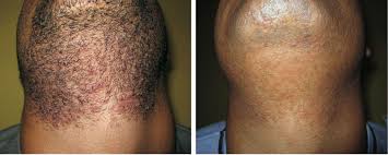 By definition, an ingrown hair is just a hair that is doing its job by growing, but is obstructed by clogged pores. Never Suffer From Ingrown Hairs Again London Premier Laser