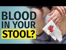 Image result for Blood in stool