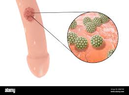 Image result for genital warts