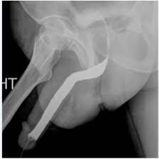 Image result for Retrograde Urethrogram