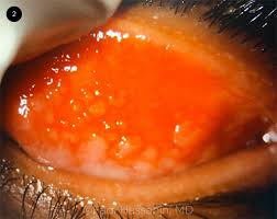 Image result for Conjunctivitis Resources