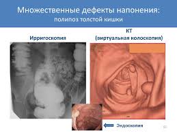 Използва се за откриване на възпалителни заболявания, полипи и рак. Luchevye Metody Issledovaniya Zheludochnokishechnogo Trakta Osnovnye Sindromy Patologii Pishevoda Zheludka I Tolstoj Kishki Prezentaciya Onlajn