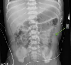 Image result for Necrotizing Enterocolitis