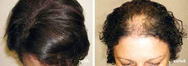 Cette perte de cheveux, notamment chez la femme , peut être expliquée et traitée de manière préventive ou curative. Ù…Ø±Ø¹Ø¨ Ø¹Ø§ØµÙØ© Ø¹Ù†ÙˆØ§Ù† ØªÙØ³ÙŠØ±ÙŠ Perte De Cheveux Cause Femme Sjvbca Org