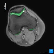 The knee joint is the junction of the thigh and leg. How To Read The Normal Knee Mri Kenhub