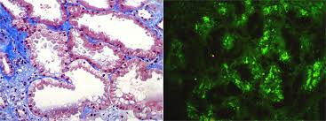 Amyloidosis And Others