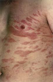 Rash is not typical for lymphoma by itself but can be seen with medications/treatment of. Non Hodgkin Lymphomas Amboss