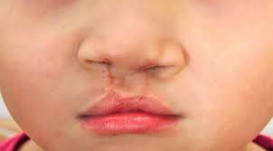 Bayi baru lahir tidak dapat mengatur temperatur tubuhnya secara memadai dan dapat dengan cepat kedinginan jika kehilangan panas tidak segera dicegah. Penyebab Bibir Sumbing Pada Bayi Baru Lahir