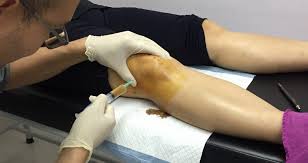 Sebelum berbicara tentang vitamin sakit lutut, mari ketahui punca sakit lutut terjadi. Suplemen Untuk Sakit Lutut Berkesan Dalam 14 Hari Klinik Dr Hasbi