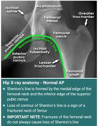 Hip X Ray Loss Of Shenton S Line Is A Sign Of Fx Neck Of Femur Medical Technology Radiology Radiology Imaging