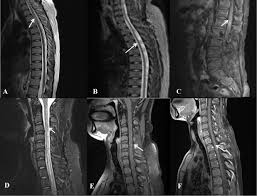 Image result for Neurosyphilis