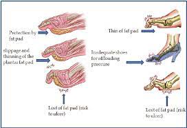 Diabetic peripheral neuropathy, present in 60% of diabetic persons and 80% of diabetic persons with foot ulcers, confers the greatest risk of foot ulceration; The Different Deformities Of At Risk Diabetic Foot The Three Download Scientific Diagram