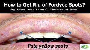This post is an extension of the getting rid of fordyce spots thread. How To Get Rid Of Fordyce Spots On Lips 6 Best Remedies