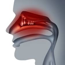 Many different medications come as nasal sprays, and instructions for how to use them can vary. Nasal Polyps Aaaai