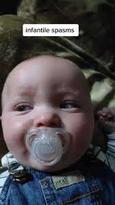 this is Toby around 5 months old, we 1st started to notice his eyes rolling  around in his head and he breathing was funny. if you watch his eyes you  will see his eyes are watering and rolling, this is ...