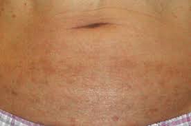 Allergic Contact Dermatitis Caused By Titanium Screws And Dental Implants Sciencedirect