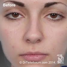 Rhinoplasty Before and After Photos by Steven Teitelbaum, MD; Santa Monica,  CA