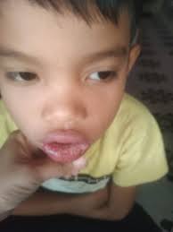 Mga mie done check Up na anak ko..may resita din na binigay pero di parin  epektibo...mas lalong lumalala. May alam ba kayong Home remedie mga mie??