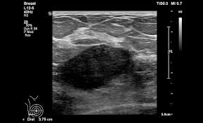 Instead, breast skin can become thick, red, and look pitted, like an orange peel. The Radiology Assistant Ultrasound Of The Breast