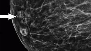 Breast compression while getting a mammogram cannot cause cancer to spread. Digital Mammography Increases Breast Cancer Detection By 14